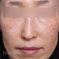 기미색소 시술 전 이미지